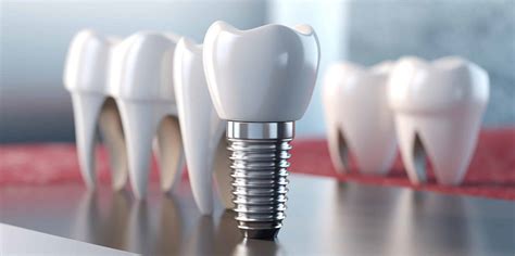 Dental Implant vs. Bridge: Pros and Cons, and which is the best for you - Edition Dental: Your ...