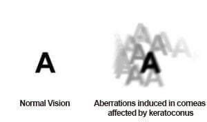 Keratoconus Treatment - C3R, CXL, Crosslinking, INTACS, ROSE-K, Scleral ...