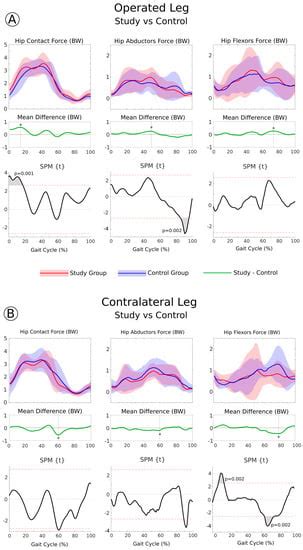 Effects of Hip Abductor Strengthening on Musculoskeletal Loading in Hip ...