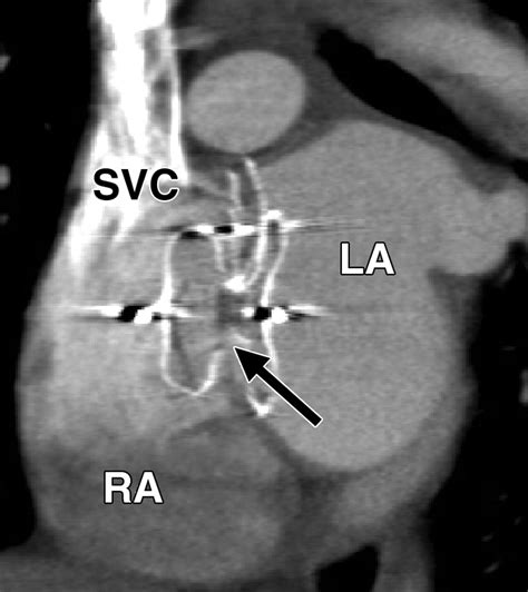 MDCT Evaluation After Closure of Atrial Septal Defect with an Amplatzer Septal Occluder | AJR
