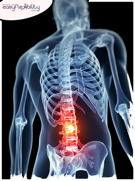 Injury Edition: Low Back Sprain – EasyFlexibility