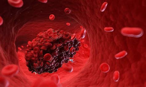 Pivotal study of minimally invasive stent therapy shows improved ...