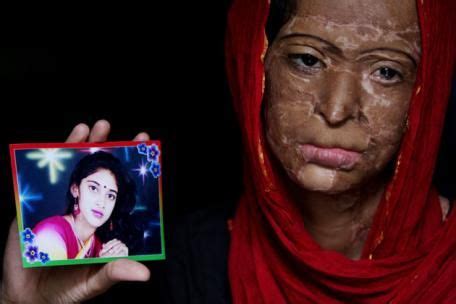 Equality Is Not Enough, Ensuring Equity In Acid Attack Legislation In India