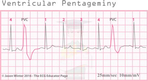 Image result for Pacemaker Programming