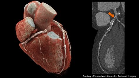 “The photon-counting CT scanner is our workhorse”
