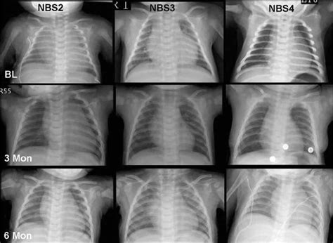 Pompe disease causes, symptoms, diagnosis, prognosis & treatment