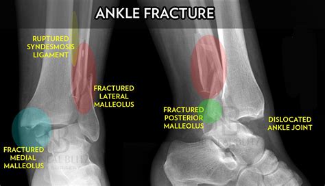 Dr. Neal Blitz | Ankle Fracture Surgery