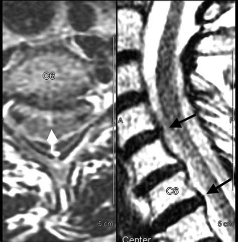 Fluid-Signal Structures in the Cervical Spinal Cord on MRI: Anterior ...