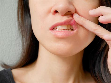 What Are the Different Types of Canker Sores?