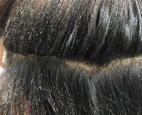 Try These Easy Home Remedies To Get Rid Of Lice Eggs | Herzindagi