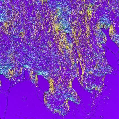 Gout Crystals: Identification & Differentiation