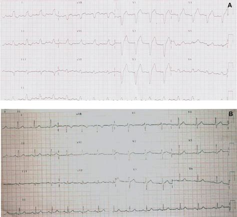 Bloqueo de rama izquierda doloroso | Revista Española de Cardiología