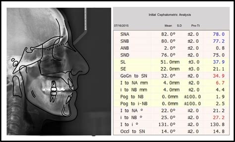 Advanced Ceramic Brackets for Patient Suffering | 3M India