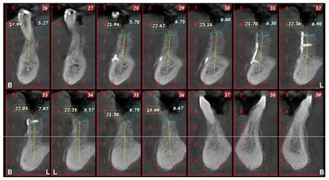 Non-Autogenous Innovative Reconstruction Method Following Mandibulectomy