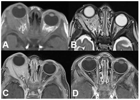 Diagnostics | Free Full-Text | Orbital Tumors—Clinical, Radiologic and Histopathologic Correlation