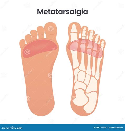 Metatarsalgia Pain in the Ball of the Foot Medical Educational Vector ...