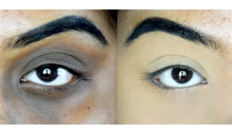 Dark Circles Treatment| Chennai | Derma Med Spa The Skin Clinic