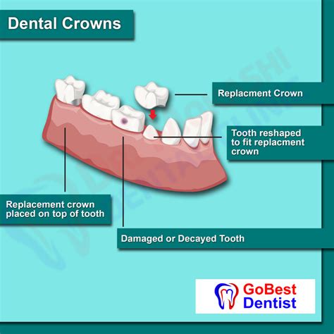 Crown-and-Bridges - Gobest Dentist