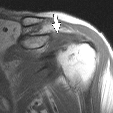 Rotator Interval Capsule Anatomy at Benjamin Ferguson blog