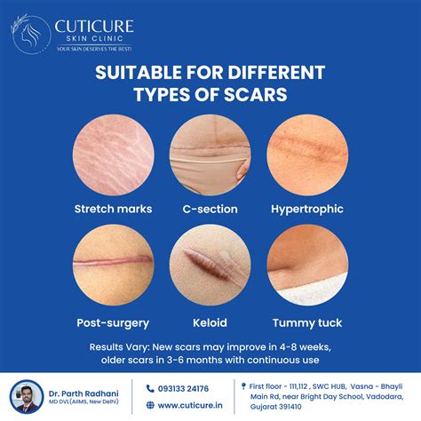 Keloids vs Hypertrophic Scars: Treatment Tips