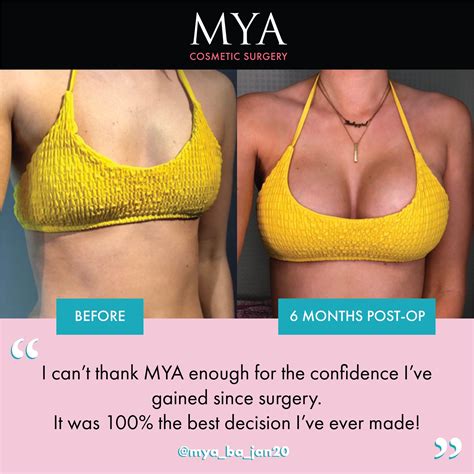 Breast Augmentation Before And After High Profile