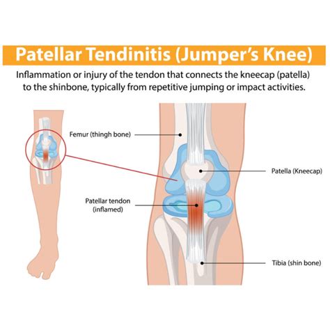 Patellar Tracking: Causes, Braces, & Recovery Solutions from ...