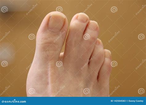 Webbed Toes on the Right Foot. Stock Image - Image of mutation, deformed: 142504583