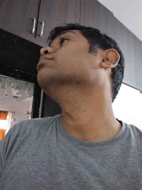 How to heal acne scars??? : r/malegrooming