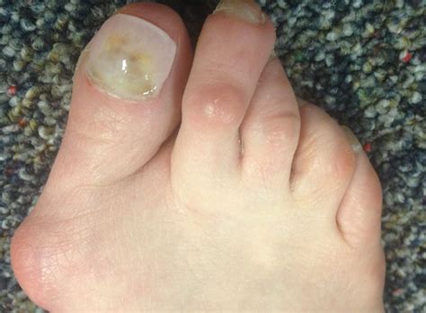 Bunion Treatment At Home