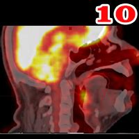 Radiotherapy | Targeting Cancer