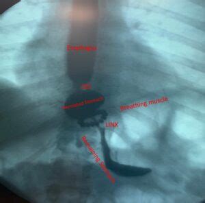 Slipped Stomach Through LINX™ Device - Houston Heartburn and Reflux Center