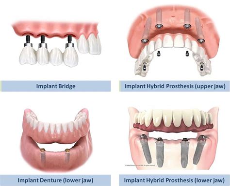 Image result for Different Types of Teeth Implants