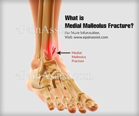 Medial Malleolus Fracture|Causes|Symptoms|Treatment|Recovery Time|Diagnosis