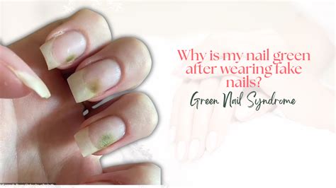 Why Is My Nail Green After Wearing Fake Nails? The Green Nail Syndrome ...