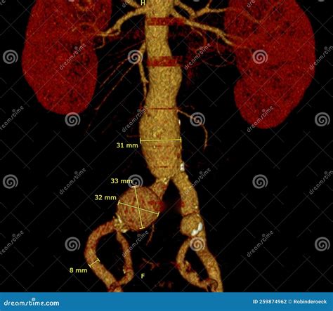 Abdominal Aortic Infrarenal Iliac Artery Aneurysm Aneurysmata Stock ...