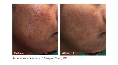 Infini | Leader Healthcare India