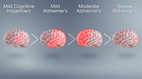 Quais São As Fases Do Alzheimer - NAZAEDU