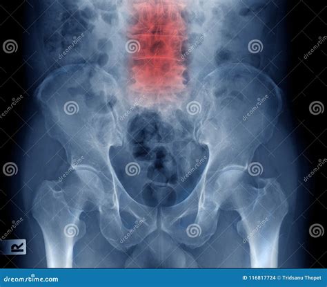 Lumbar Spondylosis X-ray Image Stock Photo - Image of pain, curve ...
