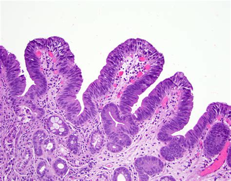 Pathology Outlines - Barrett related dysplasia