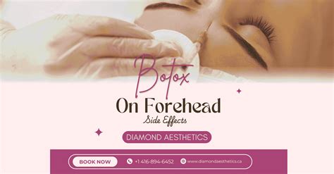 Botox on Forehead Side Effects