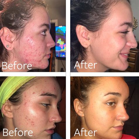 DrSong Dr Song Benzoyl Peroxide Wash 10% - Acne Treatment India | Ubuy