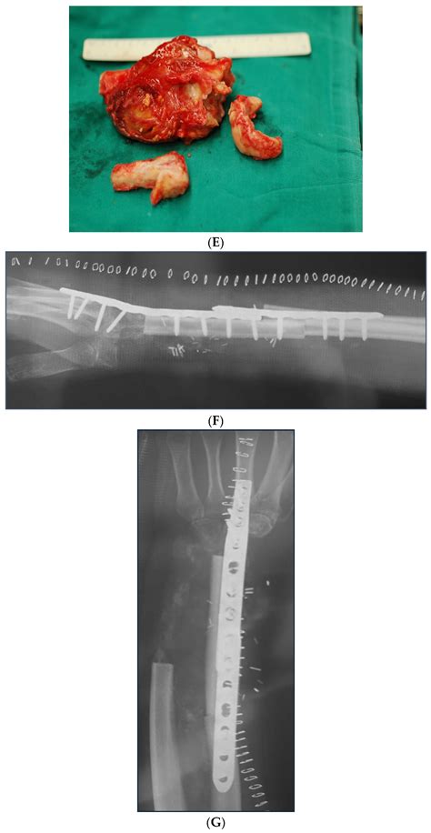 Outcomes of Free Vascularized Fibular Grafts in Treating Massive ...