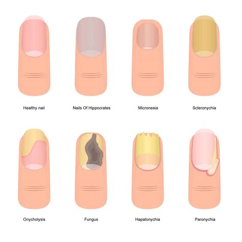 5 Shocking Reasons for White Chalky Toenails from Nail Polish