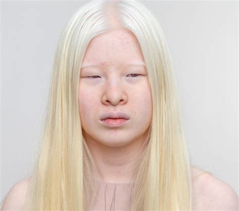 एक बीमारी के डर से मां-बाप ने छोड़ दिया था, अब बनीं दुनिया की टॉप मॉडल ...