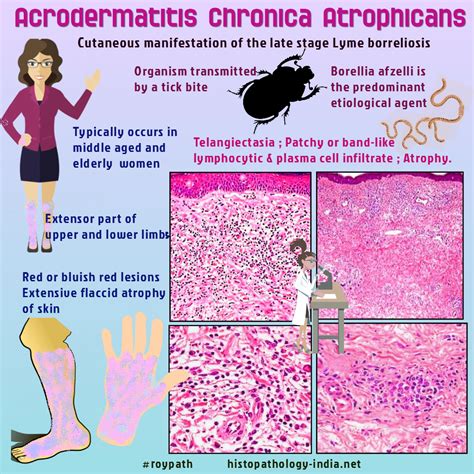 Pathology of Acrodermatitis Chronica Atrophicans | Homeopatía