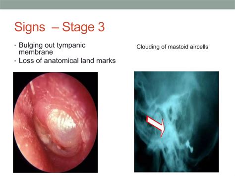 Acute otitis media | PPTX
