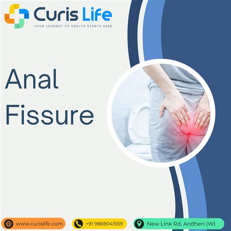 Anal Fissure Treatment in Andheri West | Curis Life Clinic