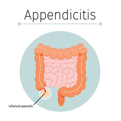Laparoscopic Appendectomy Treatment in Nerul, Navi Mumbai