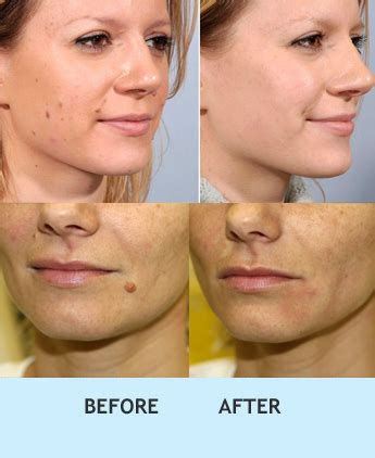 Skin Care Services in Delhi | Cosmetic Dermatology Treatments Delhi