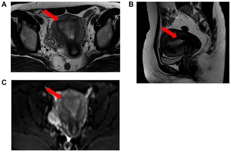 D And C Hysteroscopy Polypectomy Dilation